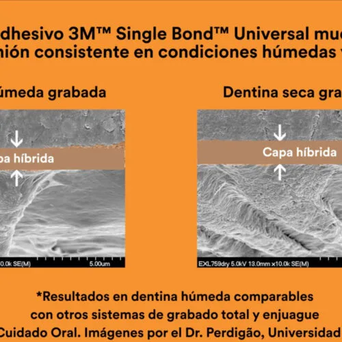 adhesivo 3M single bond universal resultados