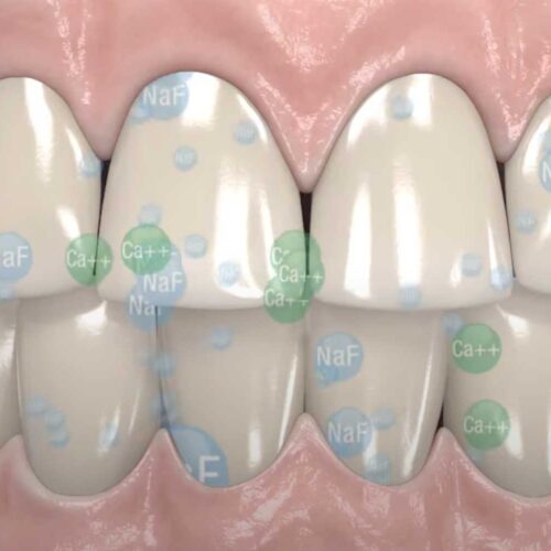 accion-fluoruro-calcio-remineralizacion-opalescence-ultradent