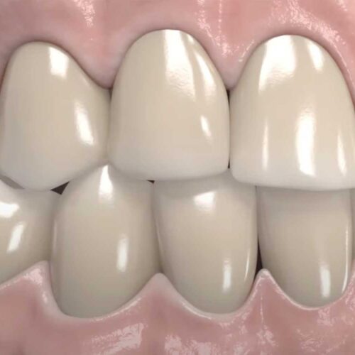 antes-cepillado-pasta-blanqueadora-opalescence-ultradent