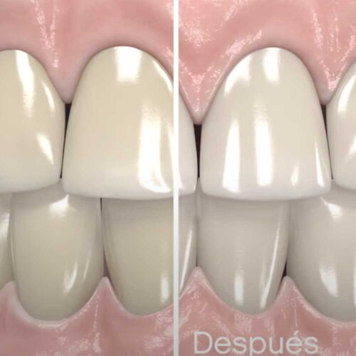 antes-despues-blanqueamiento-opalescence-ultradent
