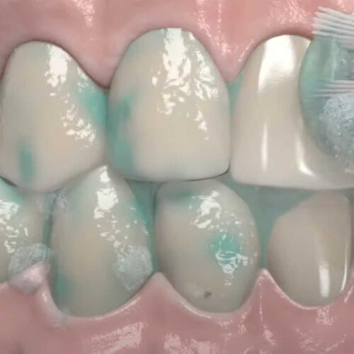 cepillado-inicial-pasta-blanqueadora-opalescence-ultradent