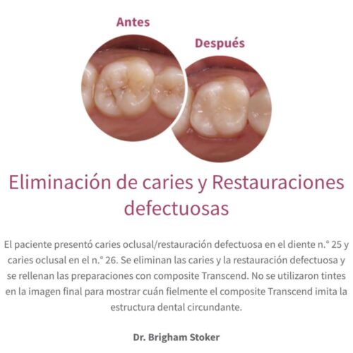 EliminacioÌn de caries y Restauraciones defectuosas