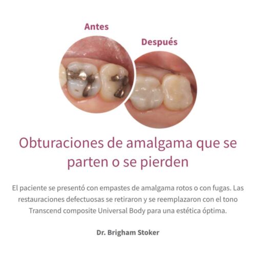 Obturaciones de amalgama que se parten o se pierden