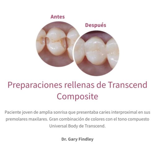 Preparaciones rellenas de Transcend Composite
