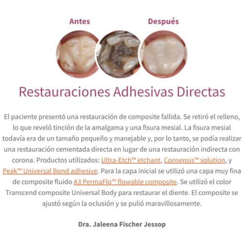 Restauraciones Adhesivas Directas